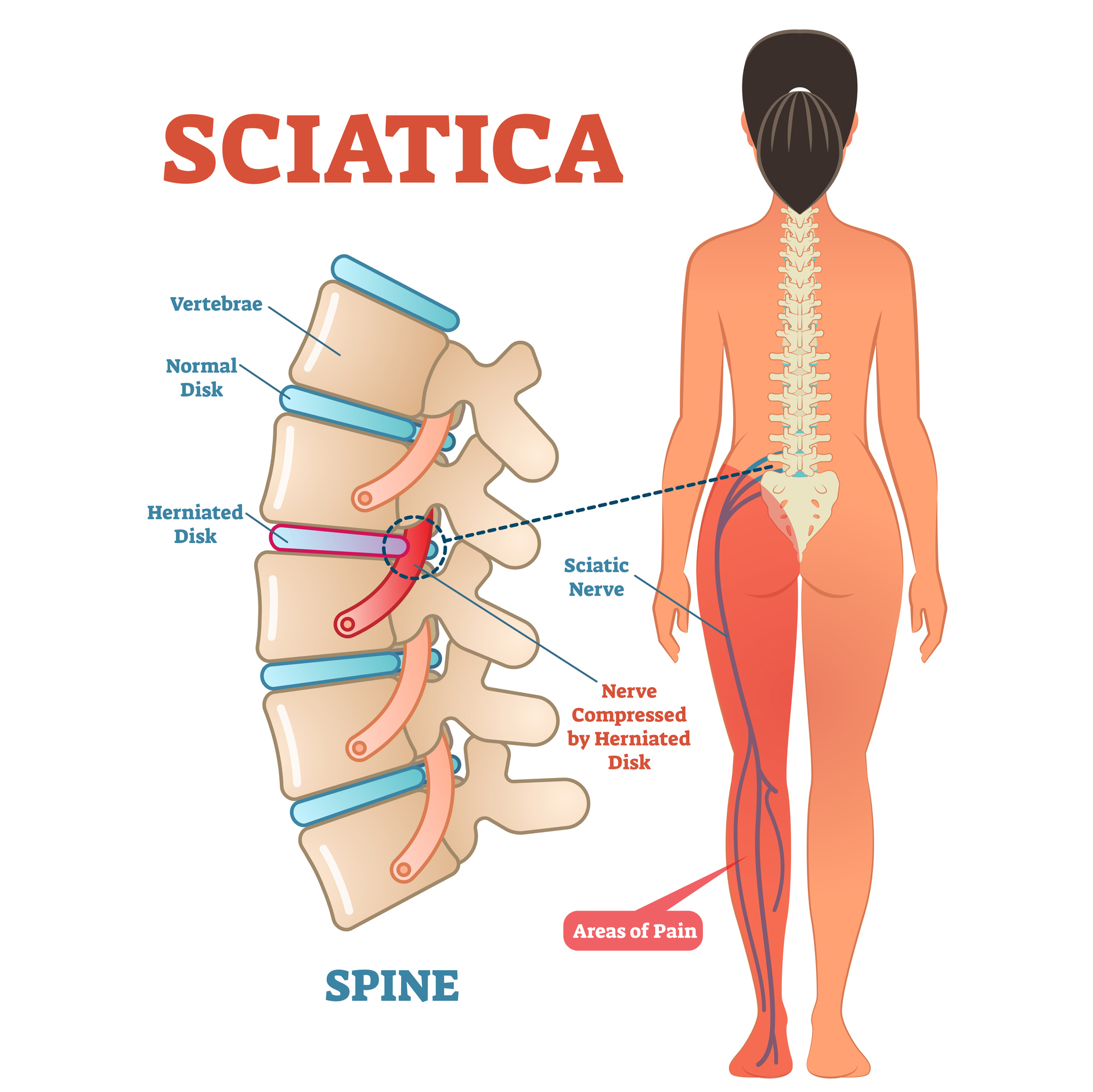 7 Sciatica Stretches a Physical Therapist Swears By - PureWow